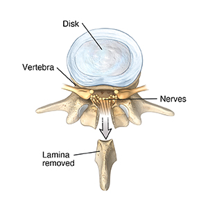 Top view of lumbar vertebra and disk showing lamina removed.