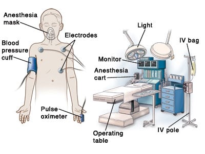 Outline of child with anesthesia mask on face, blood pressure cuff on upper arm, pulse oximeter cuff on finger, and electrodes on chest. Operating room in background shows operating table, I.V. pole, I.V. bag, anesthesia cart, monitor, and light.