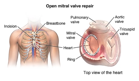 Front view of male chest showing sternal incision. Top view of heart showing mitral valve repair with a ring.