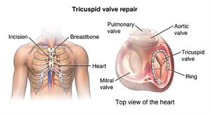 Tricuspid valve repair with location of incision, breastbone, and heart and detail of heart valves.