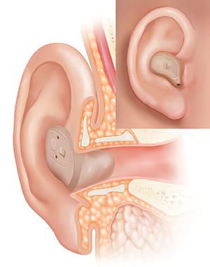 Cross section of ear showing hearing aid in place in ear canal with inset of external view.