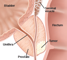 Closeup cross section of bladder, prostate, and rectum showing urethra going through prostate and seminal vesicle above prostate. Tumor is in prostate near rectum.