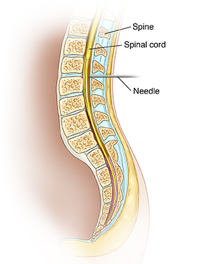 Cross section of spine showing needle inserted into epidural space in lumbar spine.