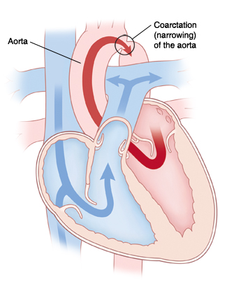 Four-chamber view of heart showing coarctation of the aorta. Arrows indicate blood flow restricted in aorta.