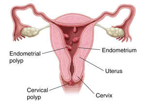 Cross section of uterus showing endometrial polyps inside uterus and cervical polyp on cervix. 