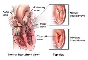 Heart with close-ups of normal tricuspid valve and damaged tricuspid valve.