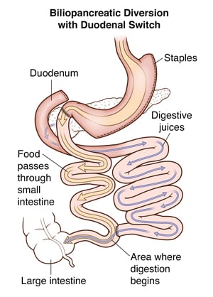 Biliopancreatic diversion with duodenal switch, showing stomach pouch and paths for food and digestive juices.