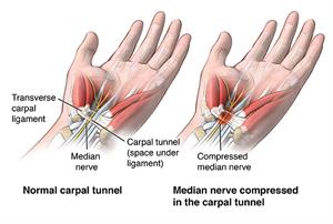 Hand with normal carpal tunnel and hand showing median nerve compressed in carpal tunnel.